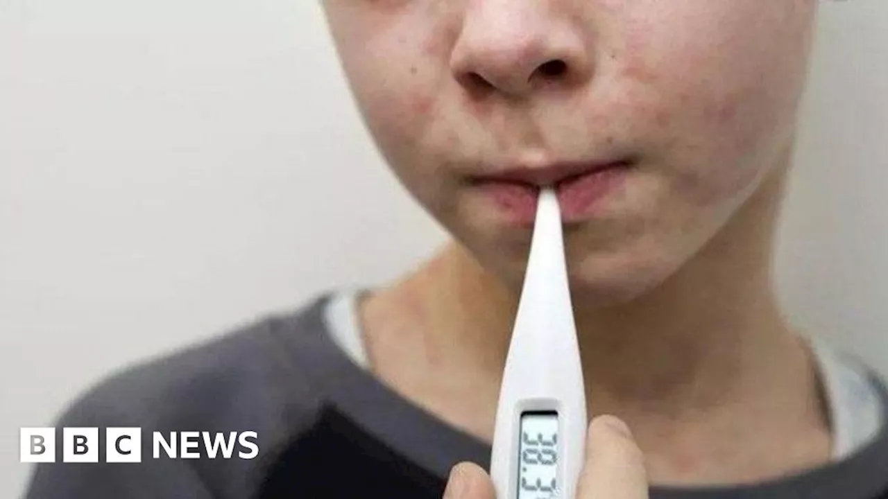 Measles Cases Surge in West Country, Parents Urged to Vaccinate