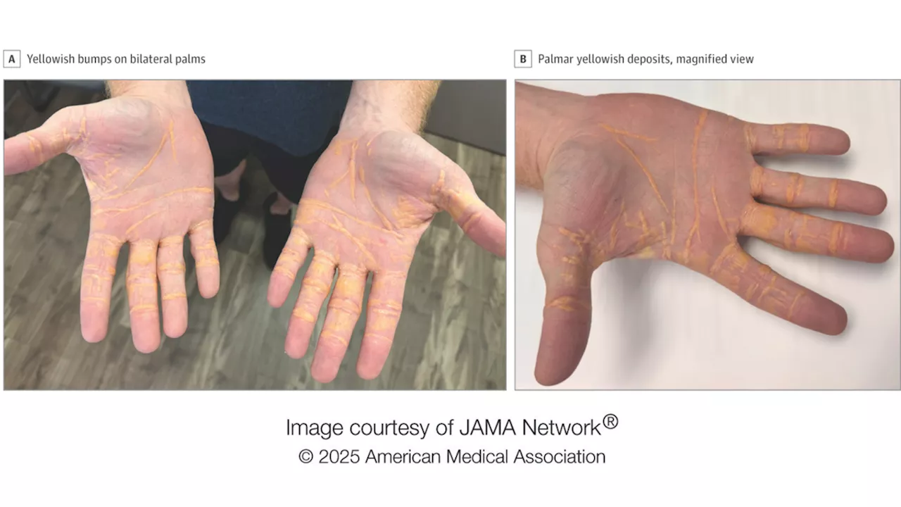 Carnivore Diet Triggers Yellow Bumps, Highlighting Cholesterol Risks