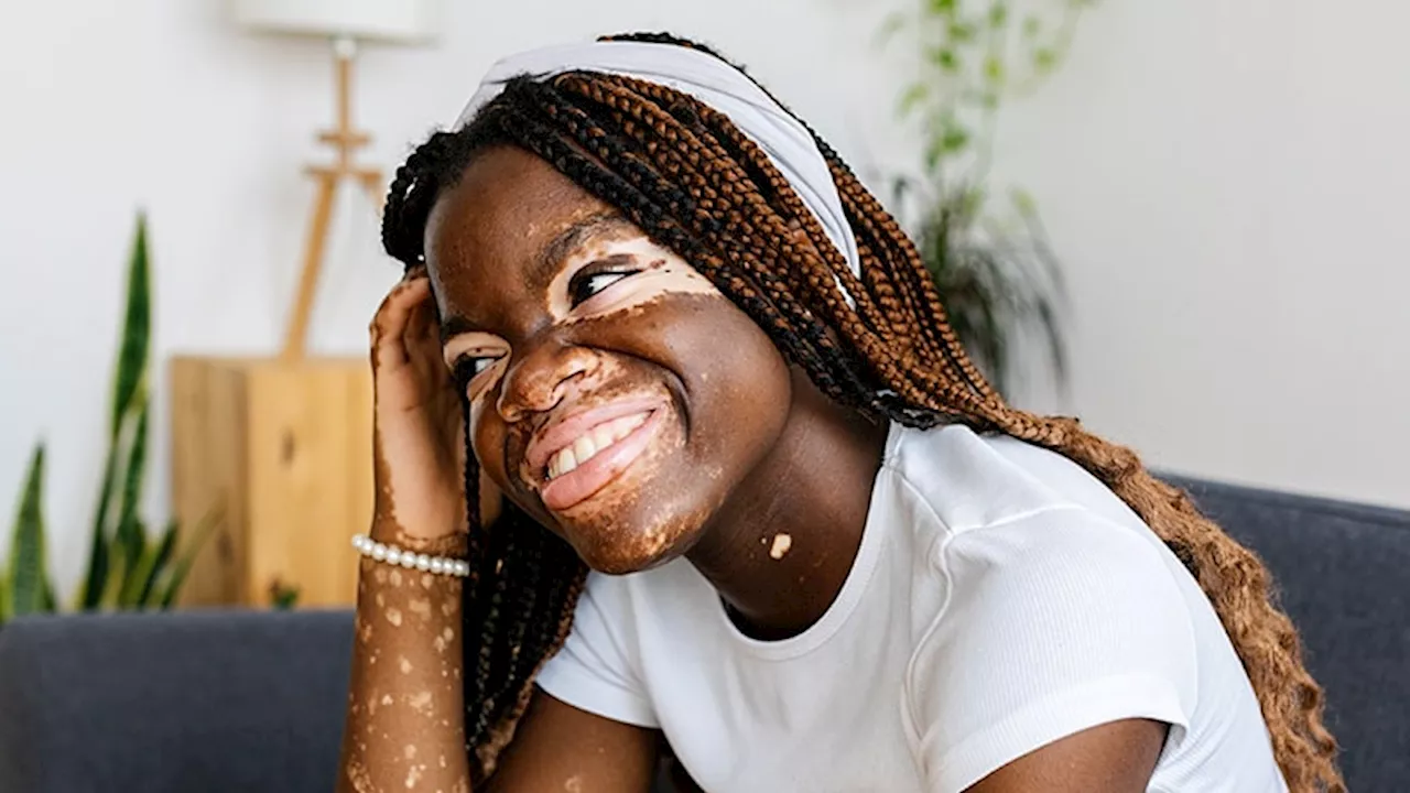 Expert Highlights Updates in Pediatric Vitiligo Care