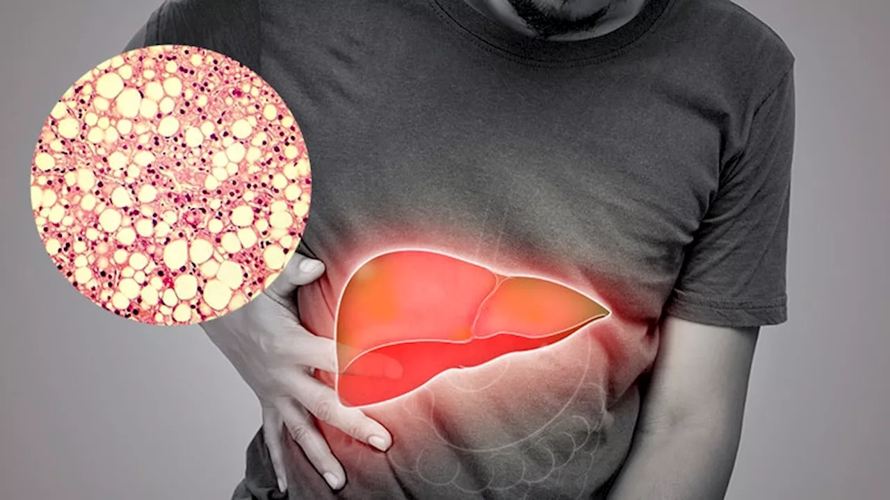 Over 5 Million Lean Adults in the United States Burdened With Liver Disease