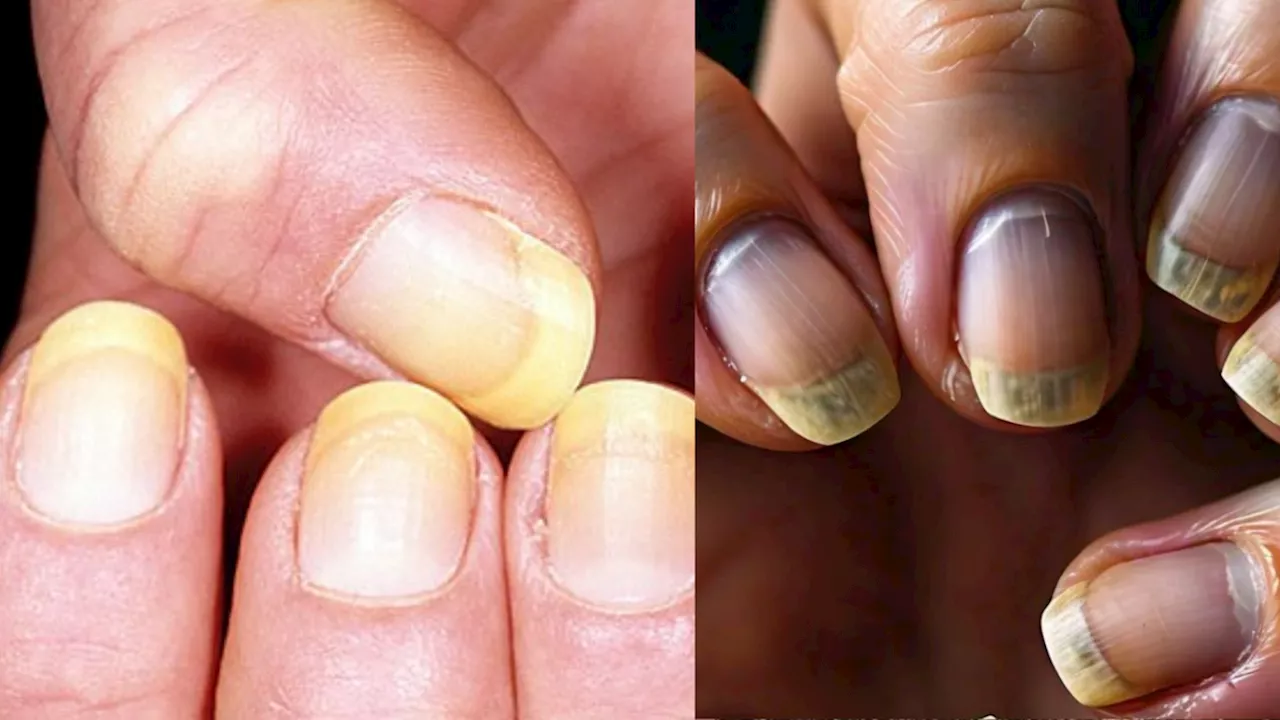 Nails Shape And Colour : नाखूनों में ये बदलाव हो सकते हैं गंभीर बीमारी के संकेत, भूलकर भी न करें इग्नोर