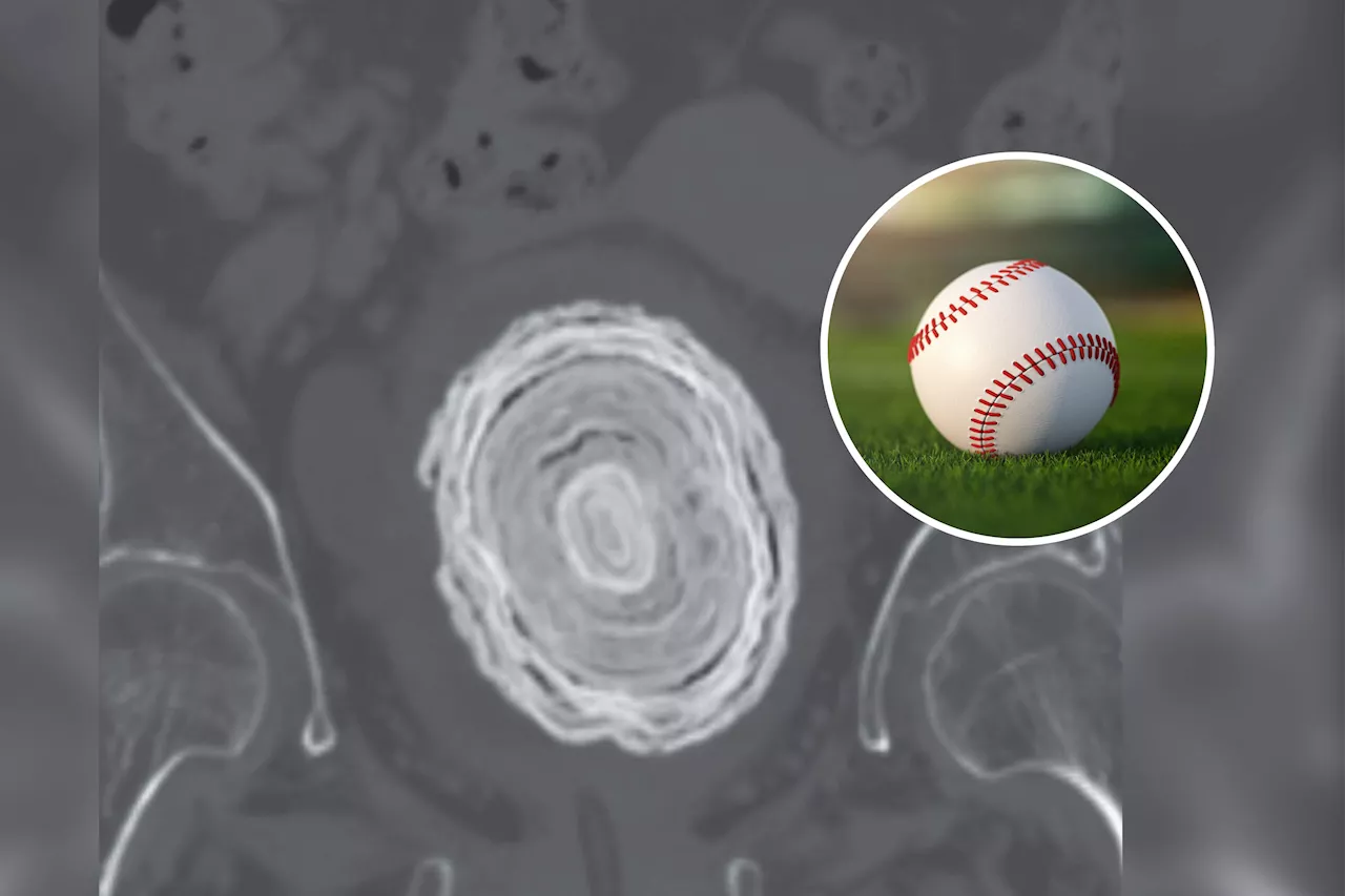 Baseball-Sized Bladder Stone with Tree-Like Rings Found in Paralyzed Woman