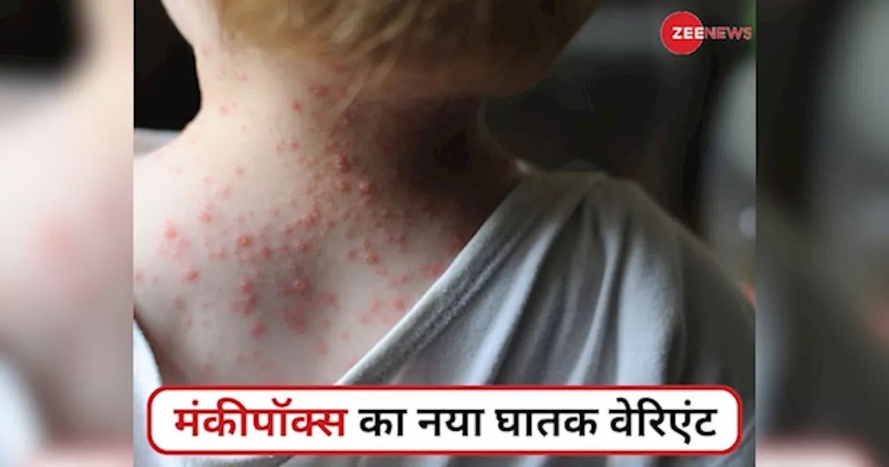 Mpox: इंग्लैंड में मिला मंकीपॉक्स का नया घातक वेरिएंट, कैसे फैल रहा है यह जानलेवा वायरस? जानें लक्षण और बचाव के तरीके