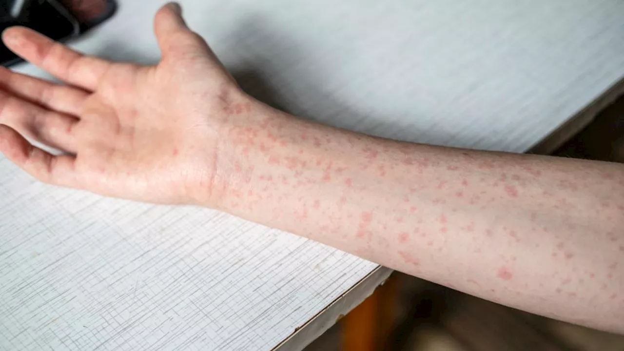 Measles Alert Issued for Sydney and Western Sydney After Overseas Cases