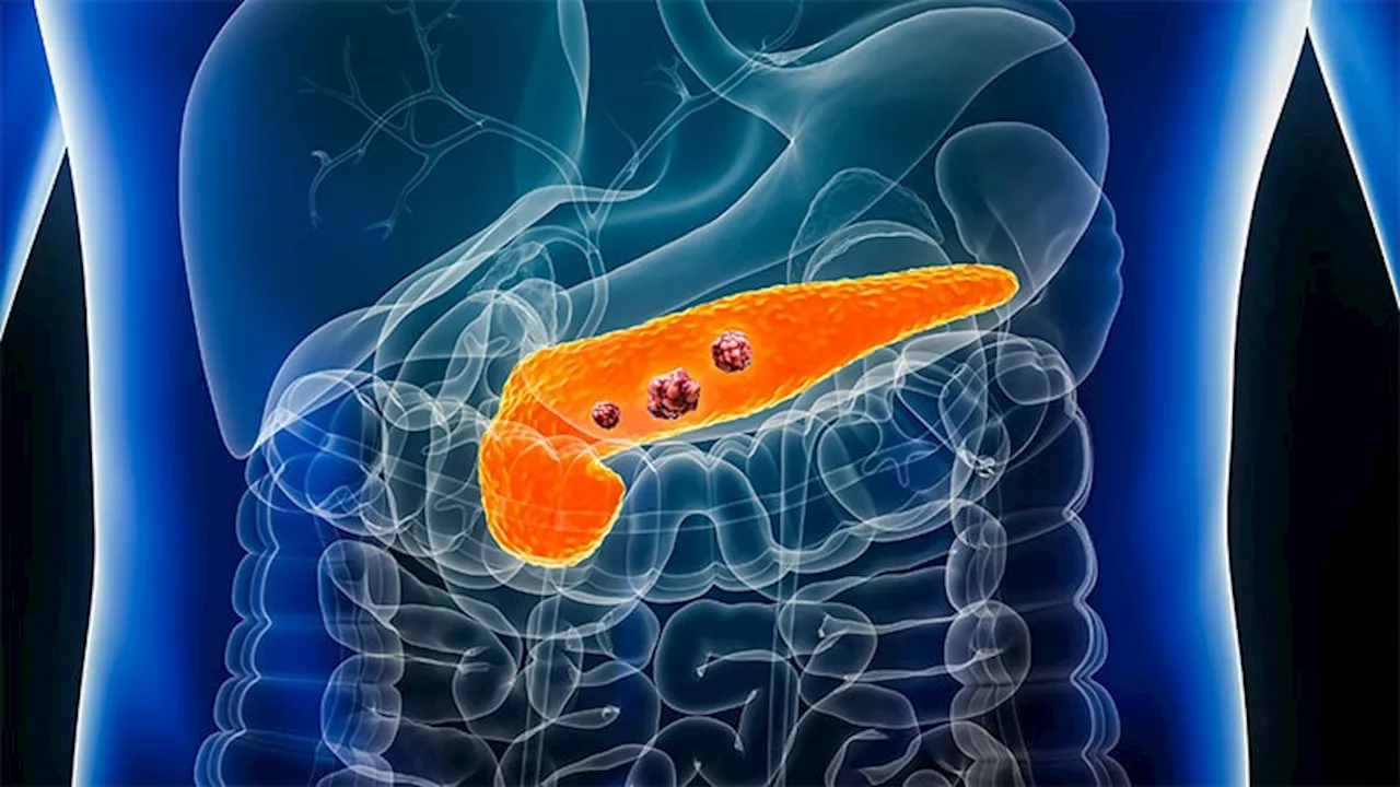 Adjuvant Chemotherapy Improves Survival in Resected Pancreatic Adenocarcinoma