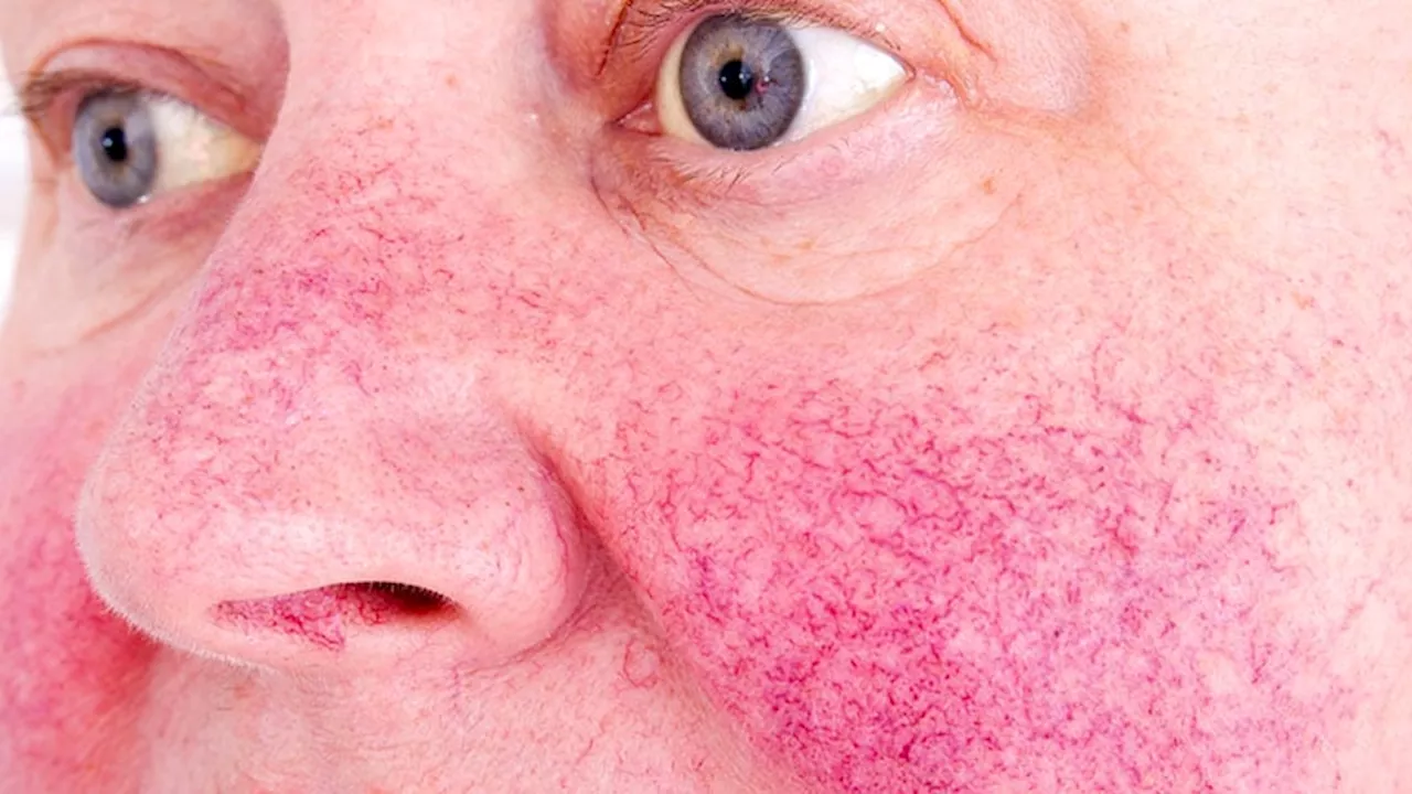 What to Make of the Comorbidities Linked to Rosacea