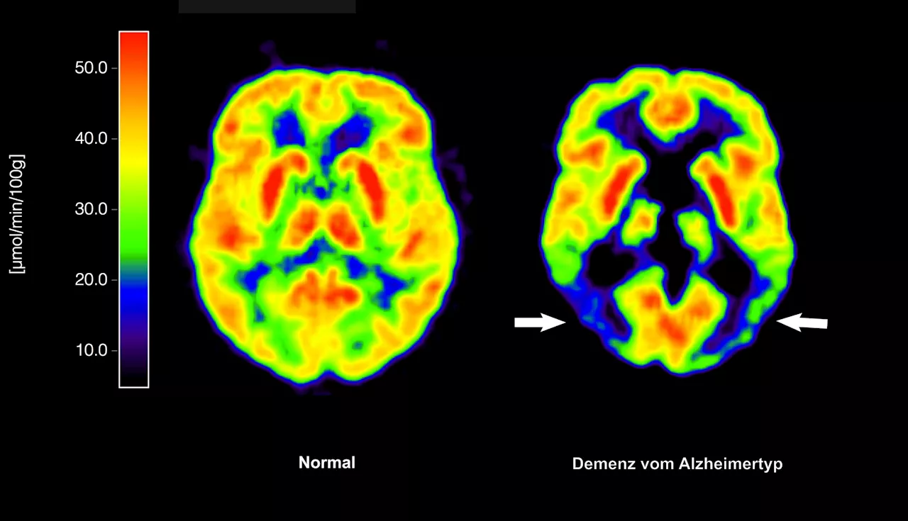 Alzheimer-Medikament: Zulassung in der EU verzögert sich