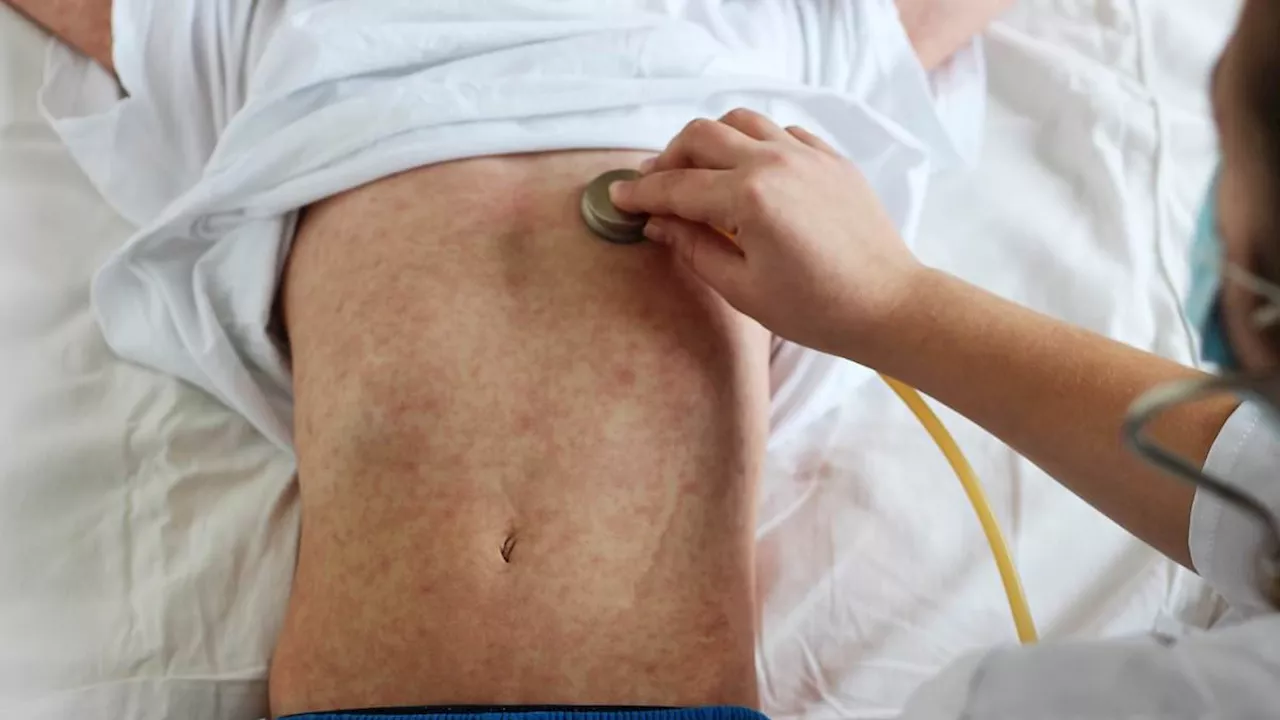 Measles Cases Surge in South England