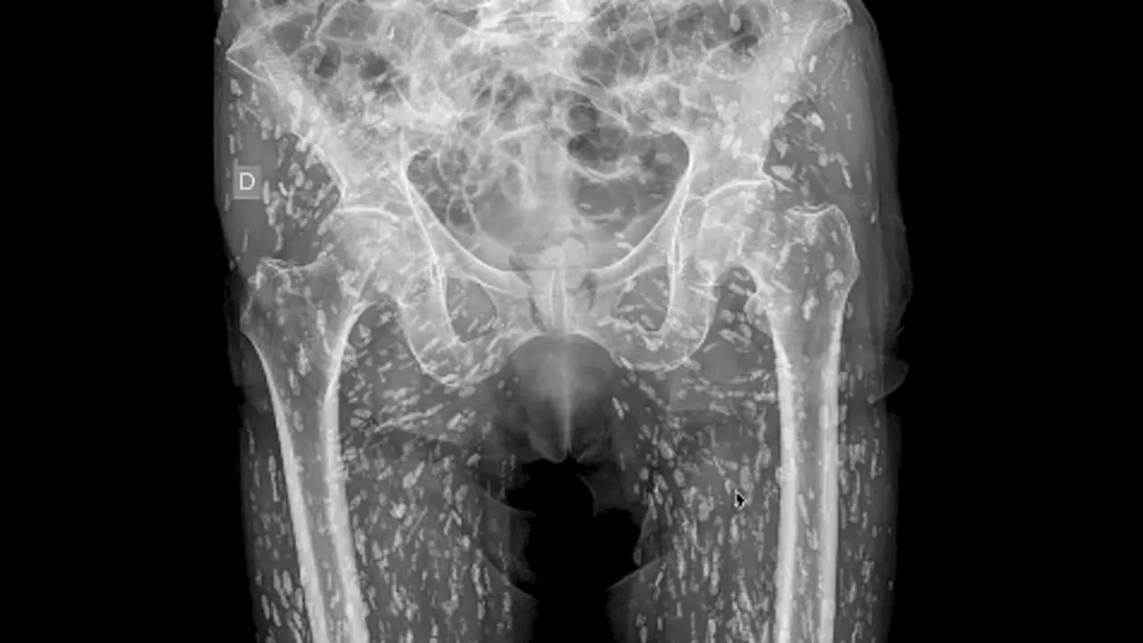 Shocking X-ray Reveals Man's Body Infested with Tapeworm Eggs