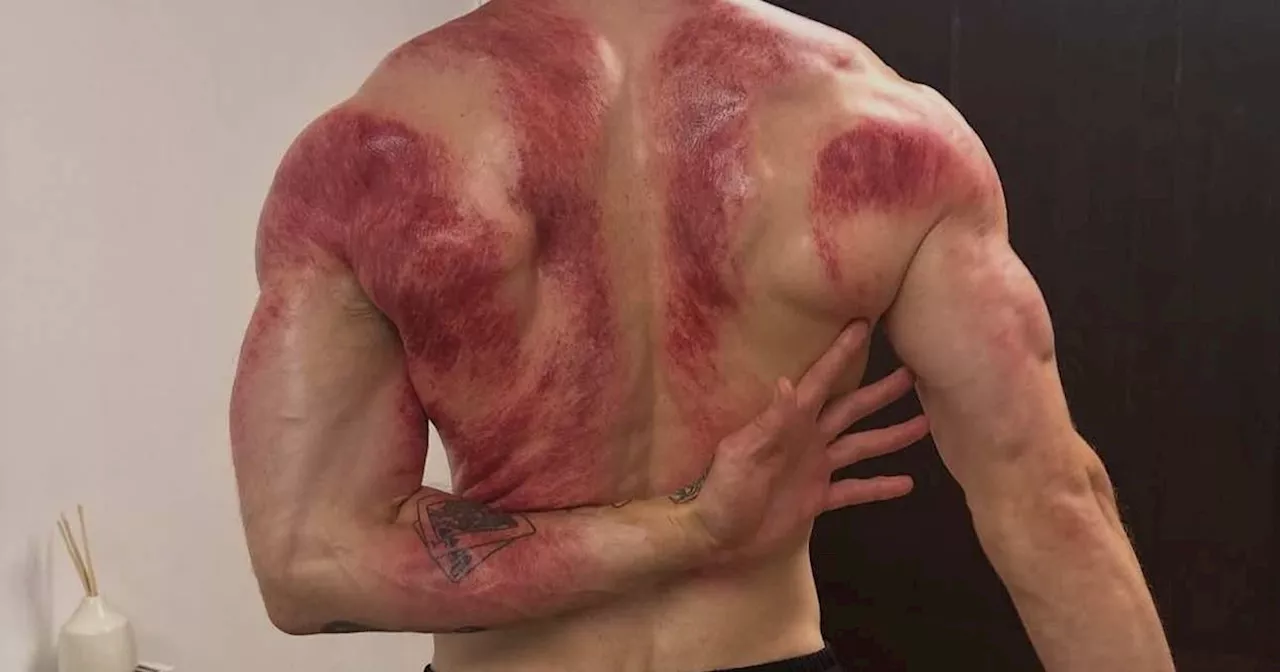 Muscle Scraper: Man's Gruesome Therapy Helps People Recover From Injuries