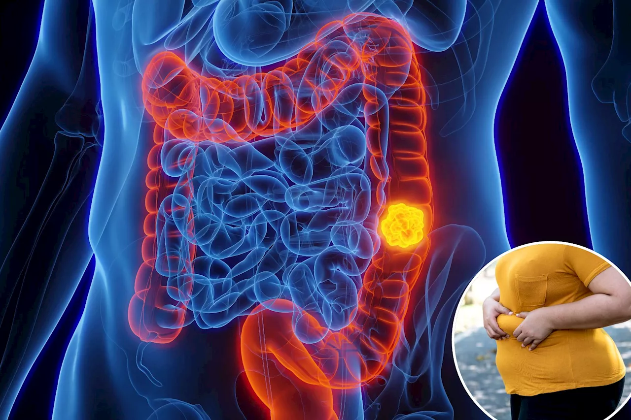 Rising Colon Cancer Cases Among Young People: Diet, Alcohol, and Obesity Linked to the Trend