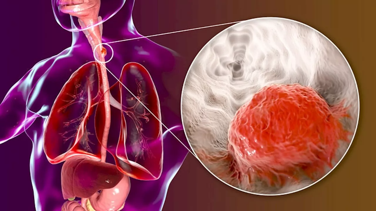 Adding PD-1 Inhibitor to Chemoradiation Boosts Complete Response in Resectable Esophageal Cancer