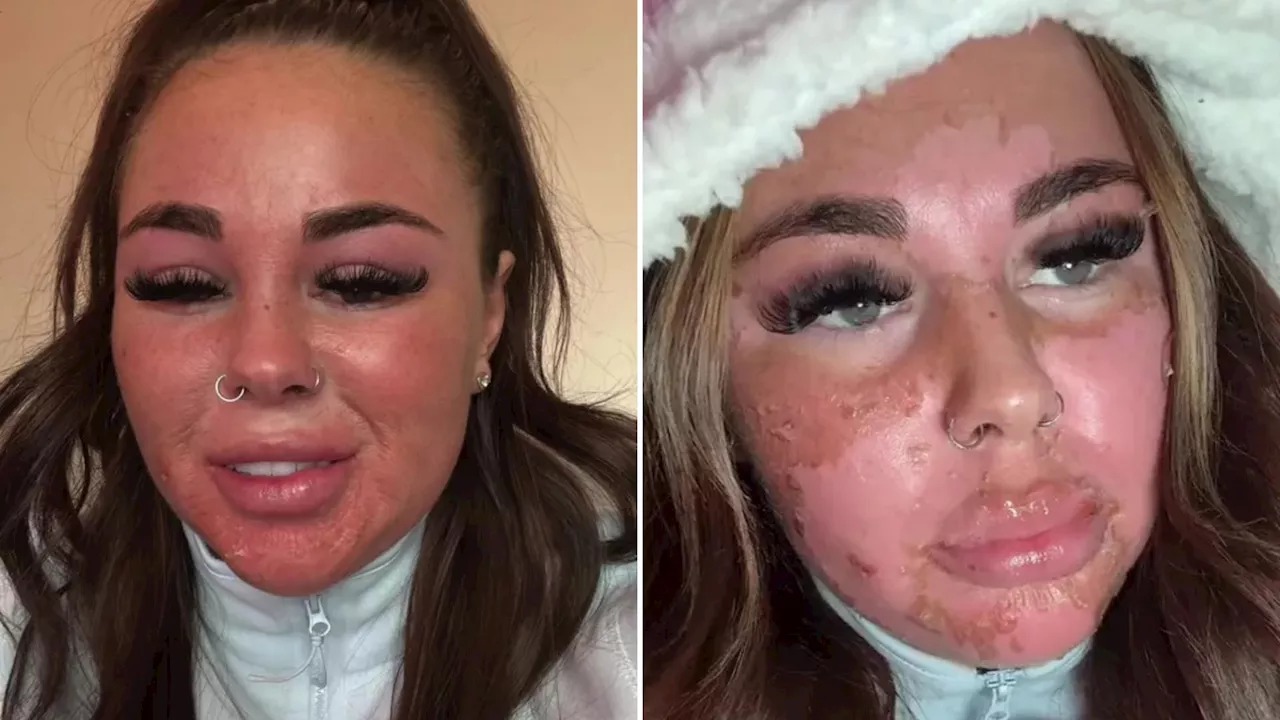 Woman's Face Peels After 20-Minute Sunbed Session