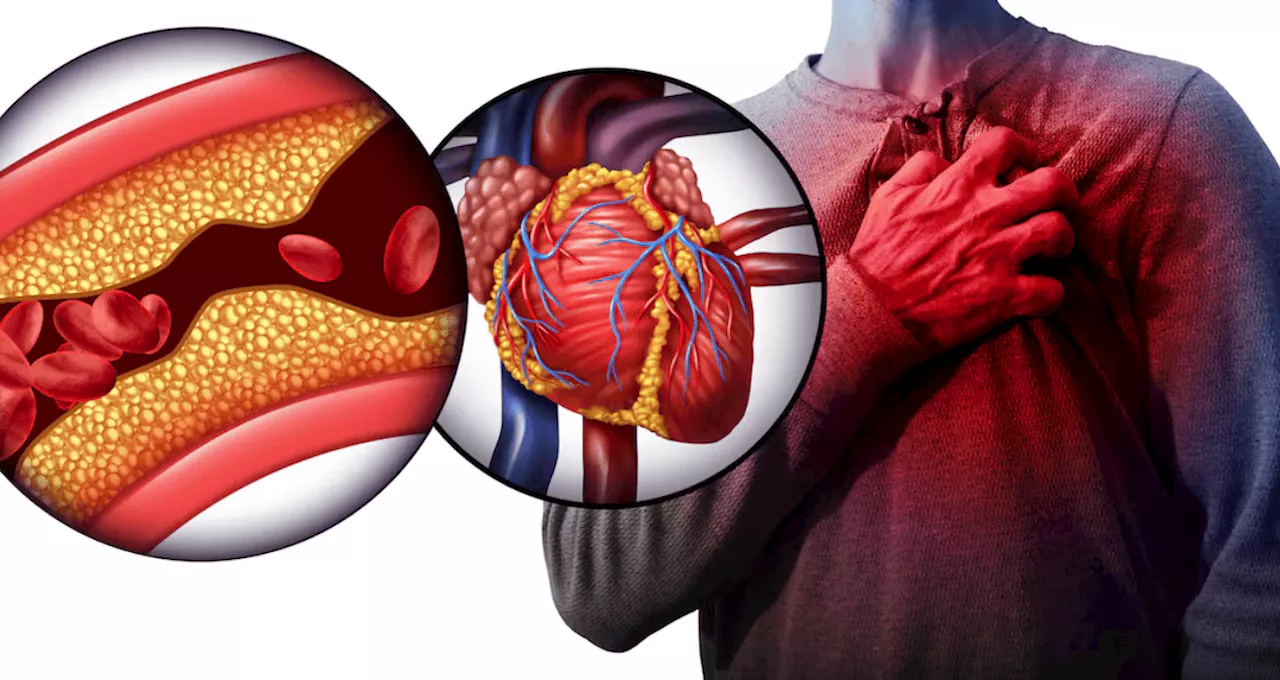 Desarrollan modelo que podría predecir el trombo ventricular izquierdo tras un infarto agudo de miocardio