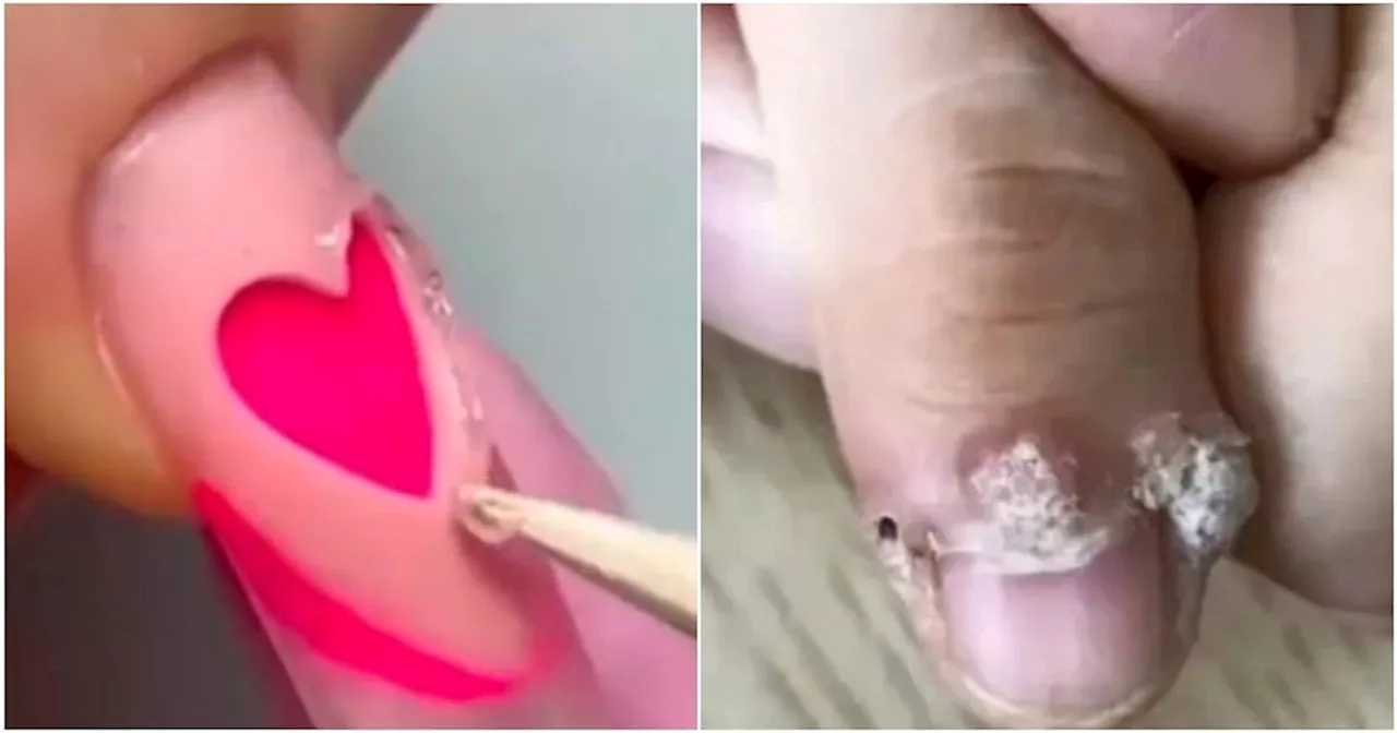 Woman in China Develops HPV Warts After Manicure