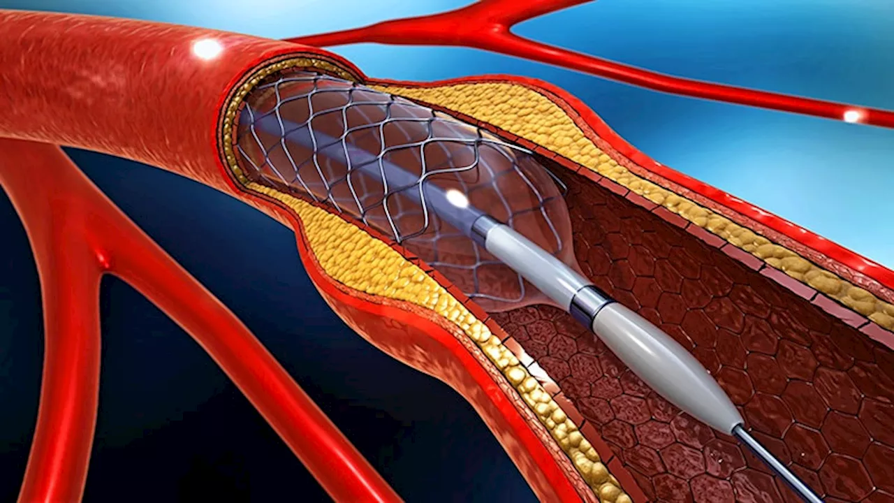 AHA Advisory Endorses Endovascular Therapy for Large Core Ischemic Stroke