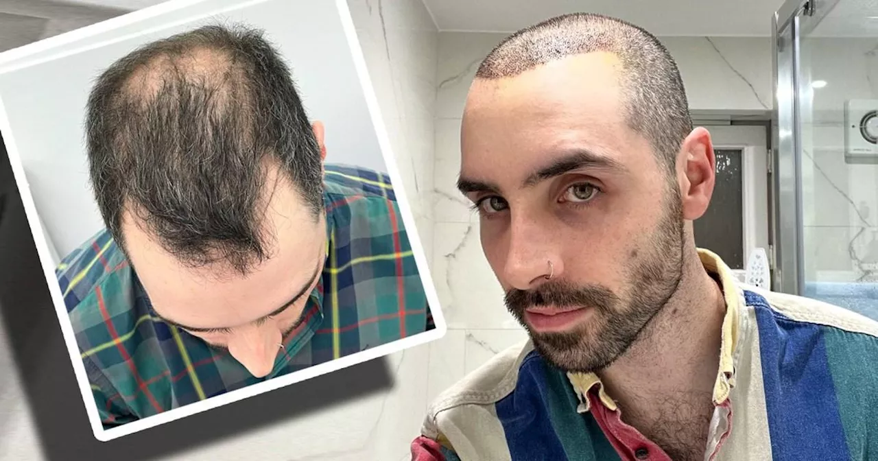 My Hair Transplant Journey: From Bald Spot to New Beginnings