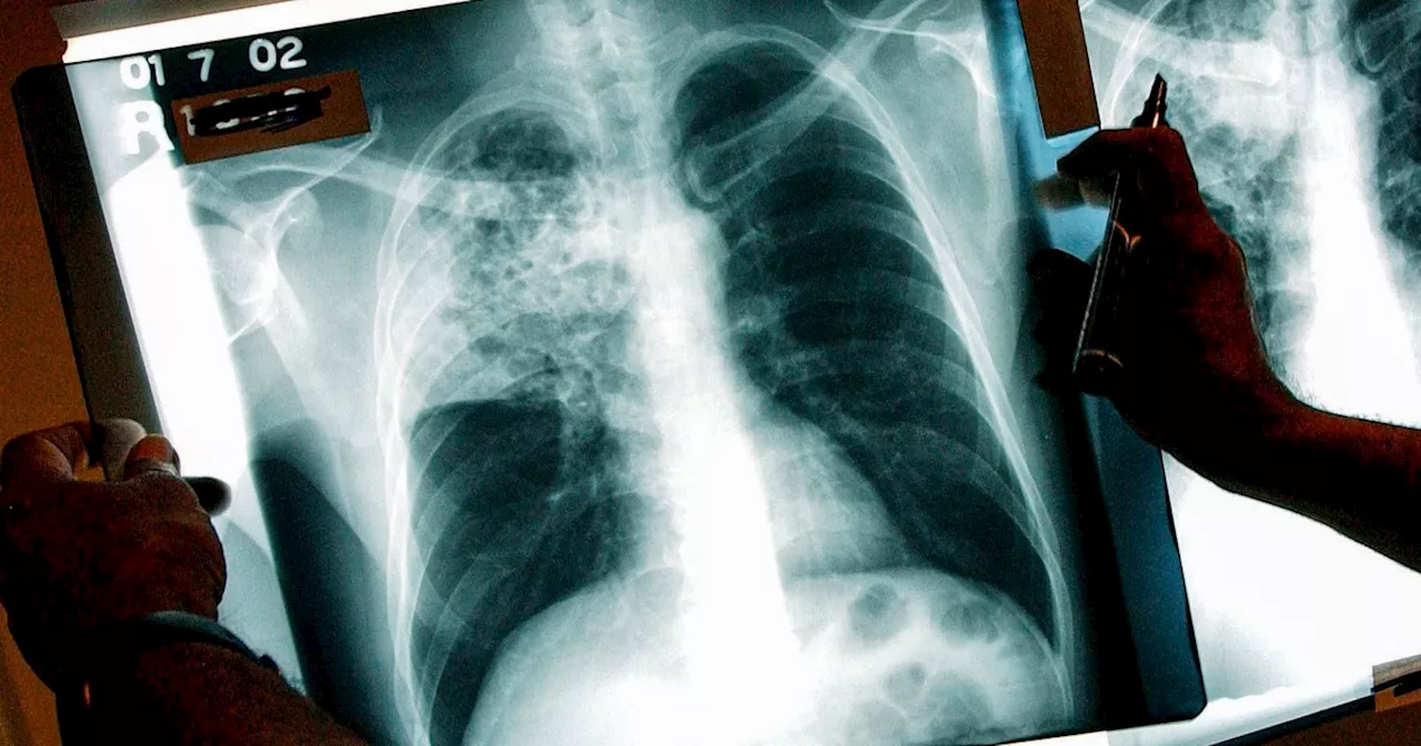 Kansas City Faces Largest Recorded Tuberculosis Outbreak in U.S. History