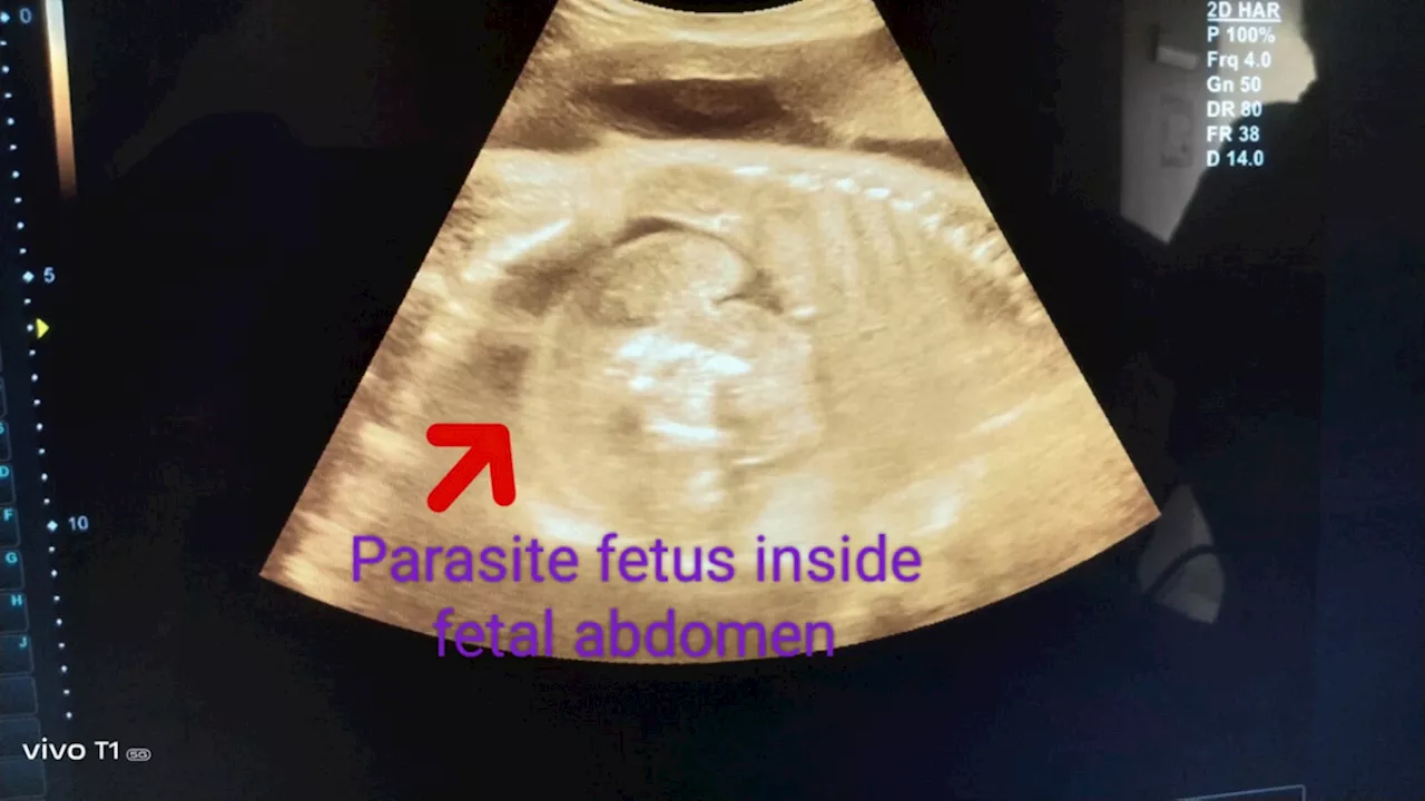 भ्रूण में भ्रूण: महाराष्ट्र में गर्भवती महिला की सोनोग्राफी में चौंकाने वाला फेज़ा