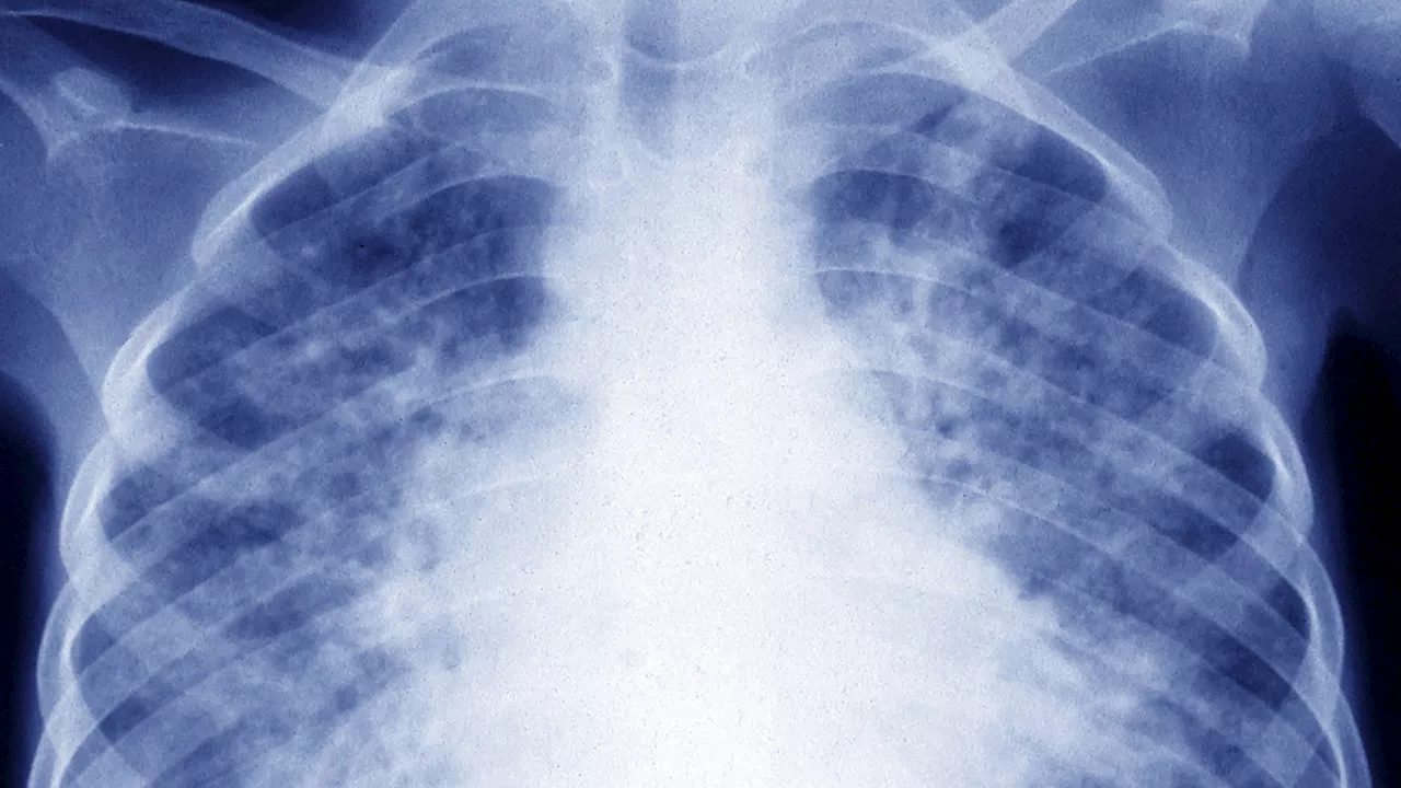 New Drug Regimens Offer Hope in Fight Against Drug-Resistant Tuberculosis