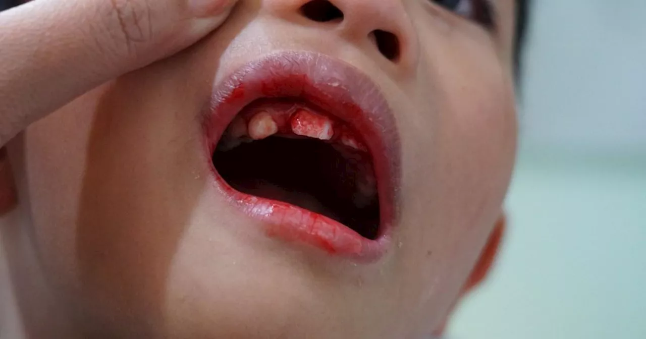 Sailor's Disease Makes a Comeback in France: Scurvy Rates Surge Among Children