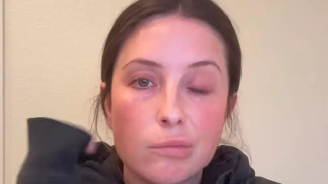 Bristol Palin reveals she's been struck by facial paralysis from neurological disorder: 'I'm...