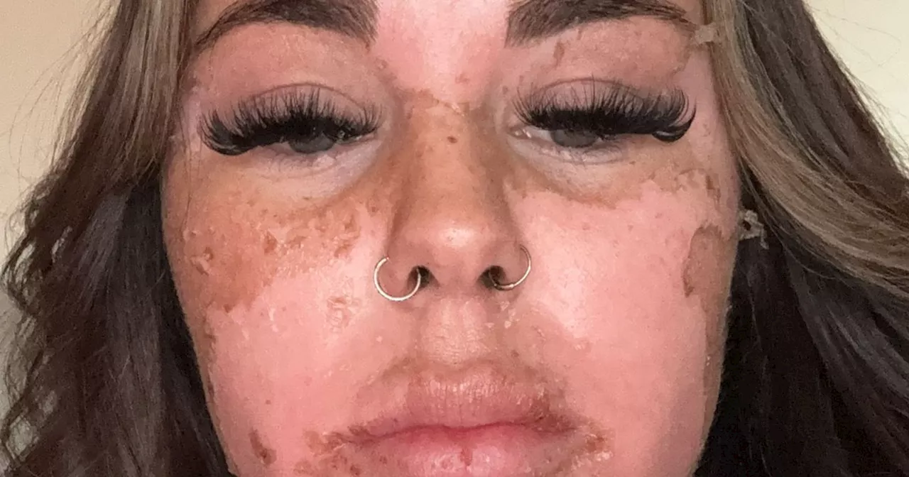 Woman warns about dangerous sunbed trick after burning skin off face