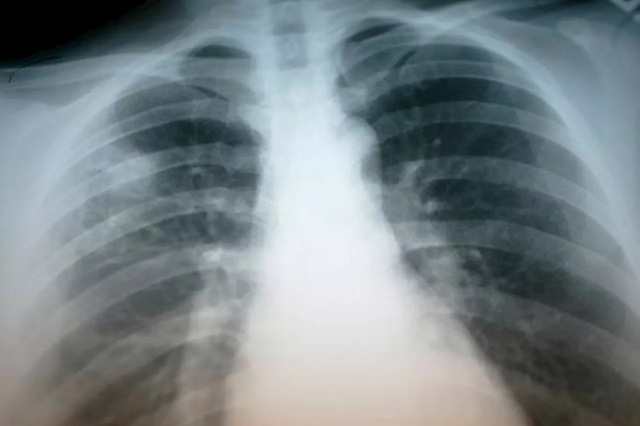 County Officials Warn of Possible Tuberculosis Exposures at Palomar High School