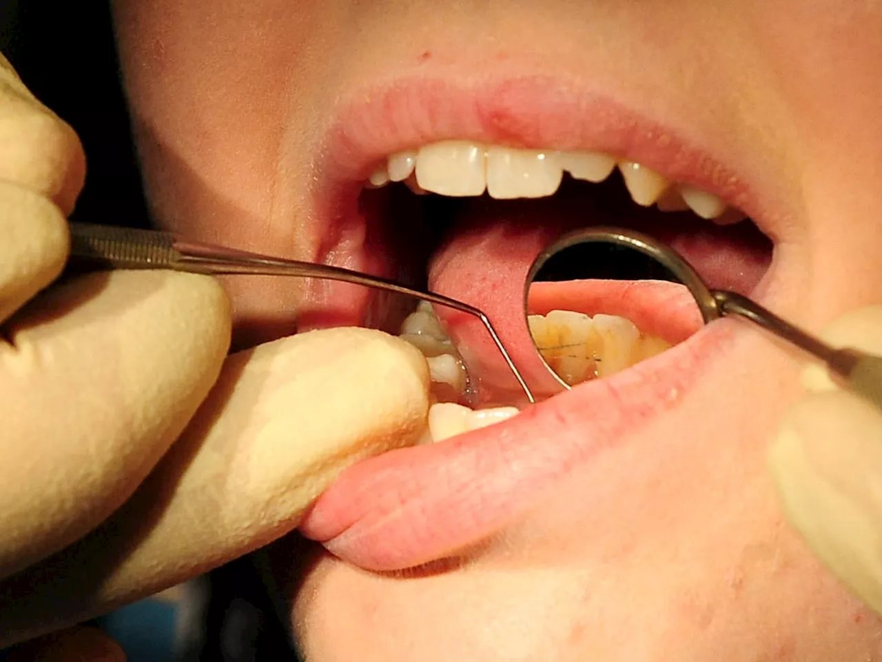 Shocking Number of Children Undergoing Tooth Extractions in Shropshire