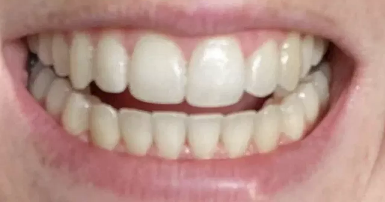 Dr. Dent Teeth Whitening Strips Offer Budget-Friendly Smile Makeover