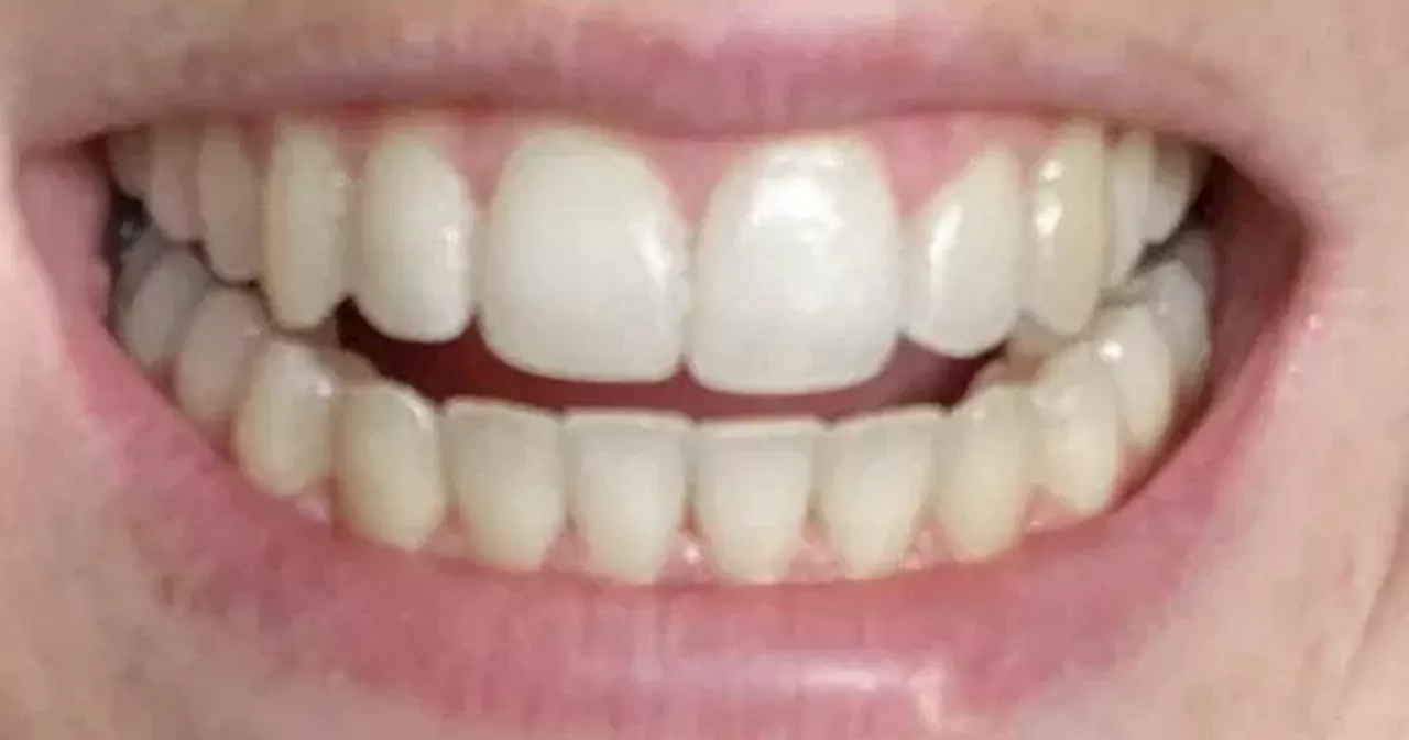 Dr. Dent Teeth Whitening Strips: Achieve a Brighter Smile for Under £1 a Day