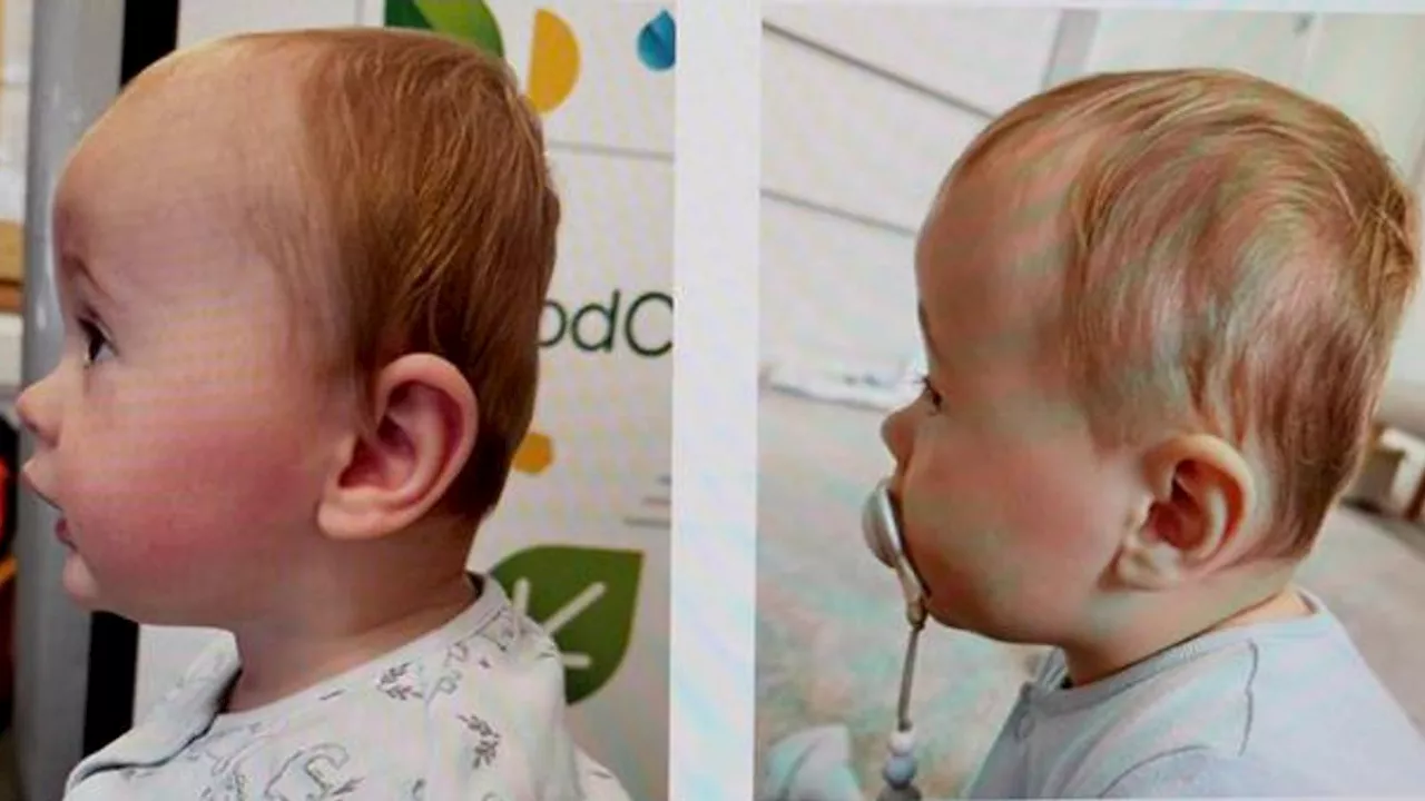 Specialist Clinic Offers Helmet Therapy for Flat Head Syndrome in Babies