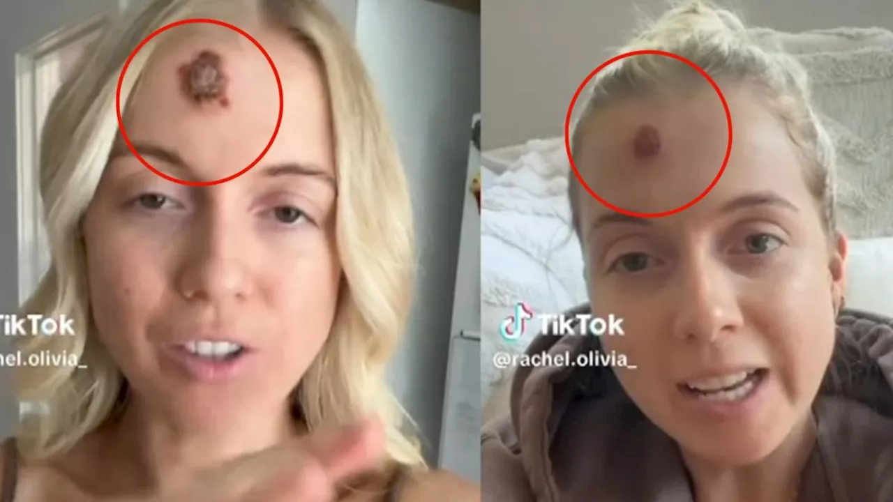 TikTok Trend Glorifying Sunburns Raises Health Concerns