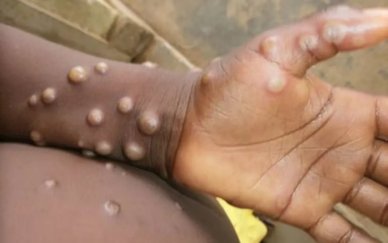 França Confirma Primeiro Caso da Nova Variante da Mpox