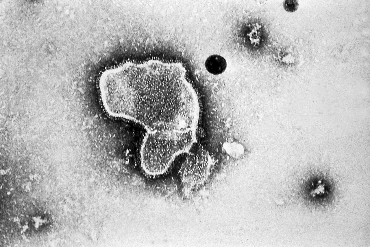 Aumento de Casos de Metapneumovírus Humano entre Crianças na China