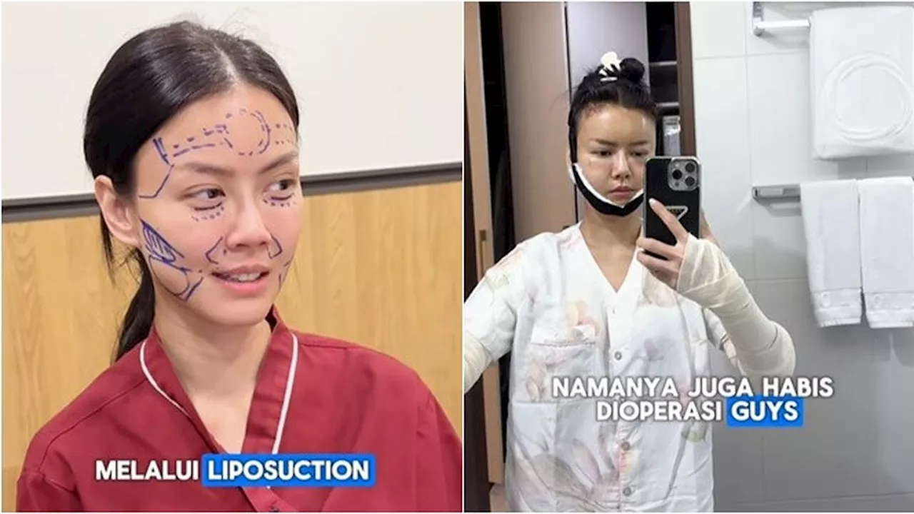 Nita Gunawan Jalani Fat Graft & Liposuction, Wajah Tampil Lebih Kenyal