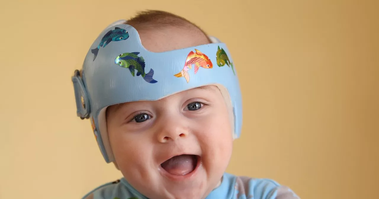 Parents Demand More Research on Flat Head Syndrome and Helmet Therapy