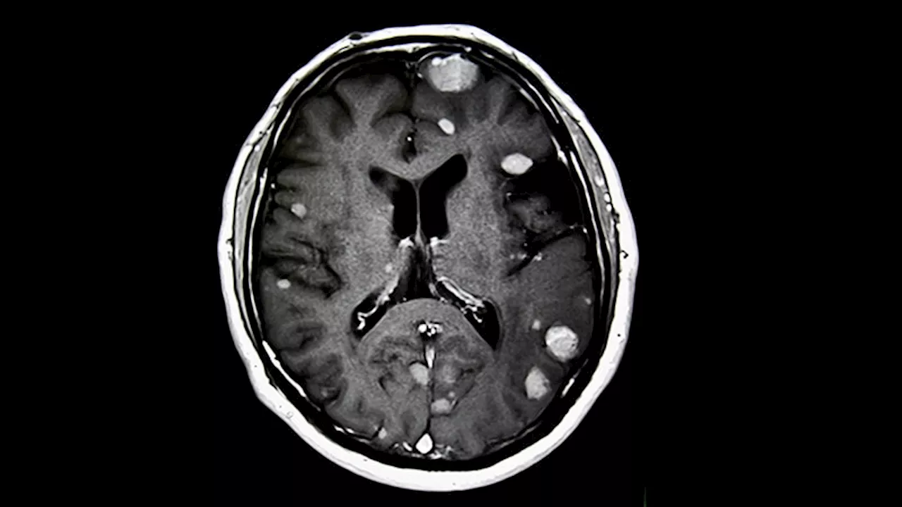 Neoadjuvant Stereotactic Radiosurgery for Brain Metastases: A New Analysis