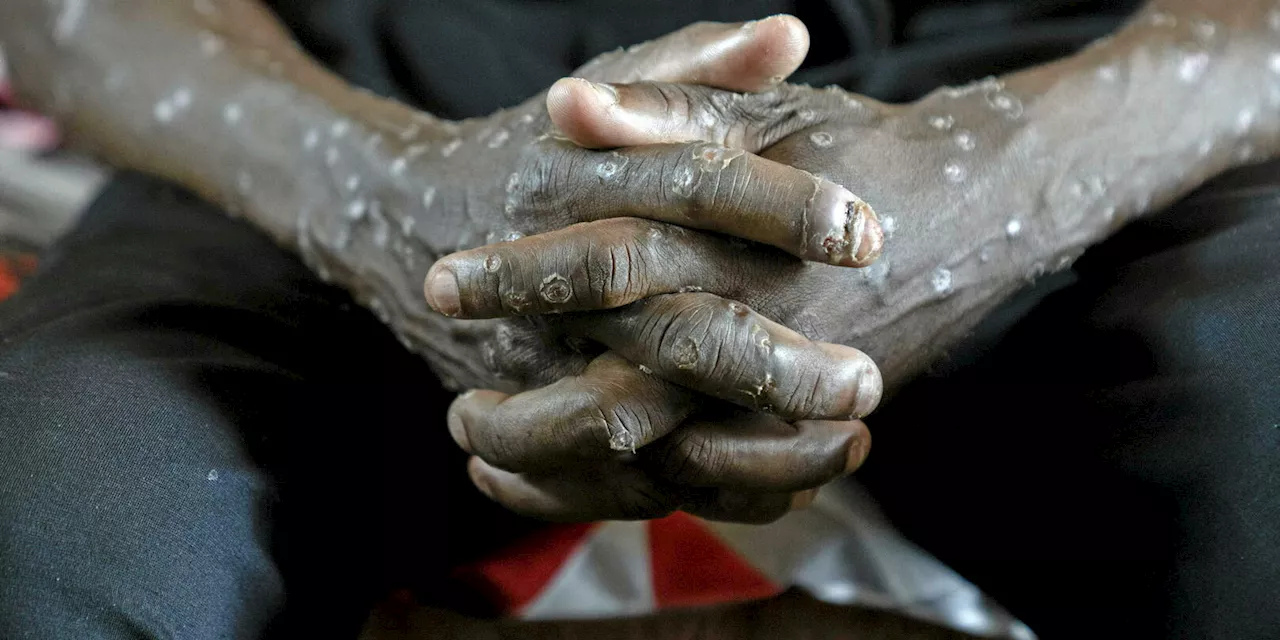 Plus dangereux et plus contagieux, le nouveau variant du mpox détecté en France