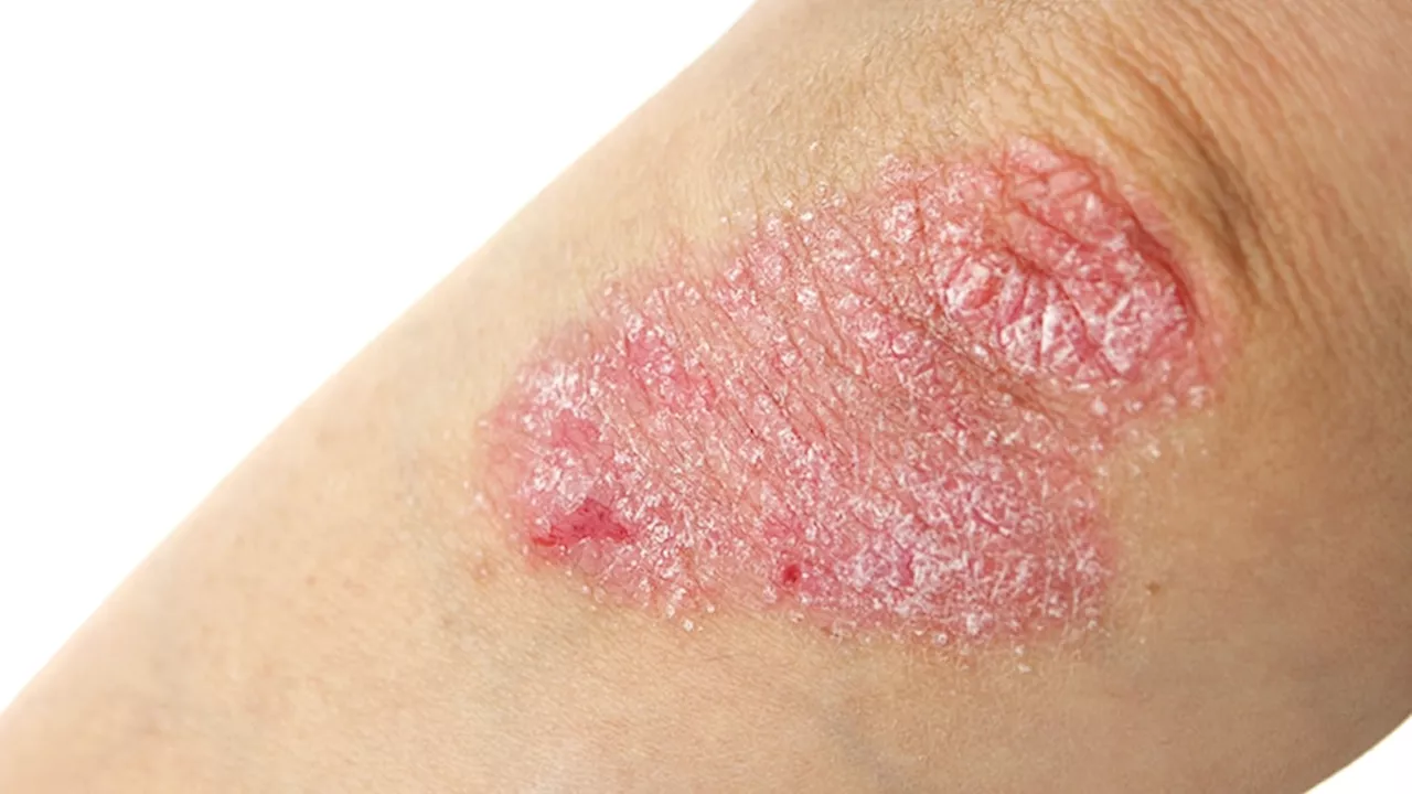 Newer Biologics Show Comparable Cardiovascular Safety to TNF Inhibitors in Psoriasis and Psoriatic Arthritis