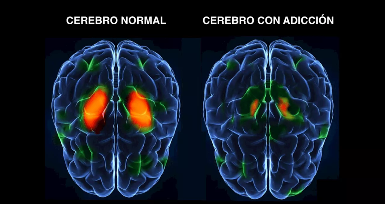 Neuroanatomía y adicción: ¿una relación más compleja de lo que se pensaba?