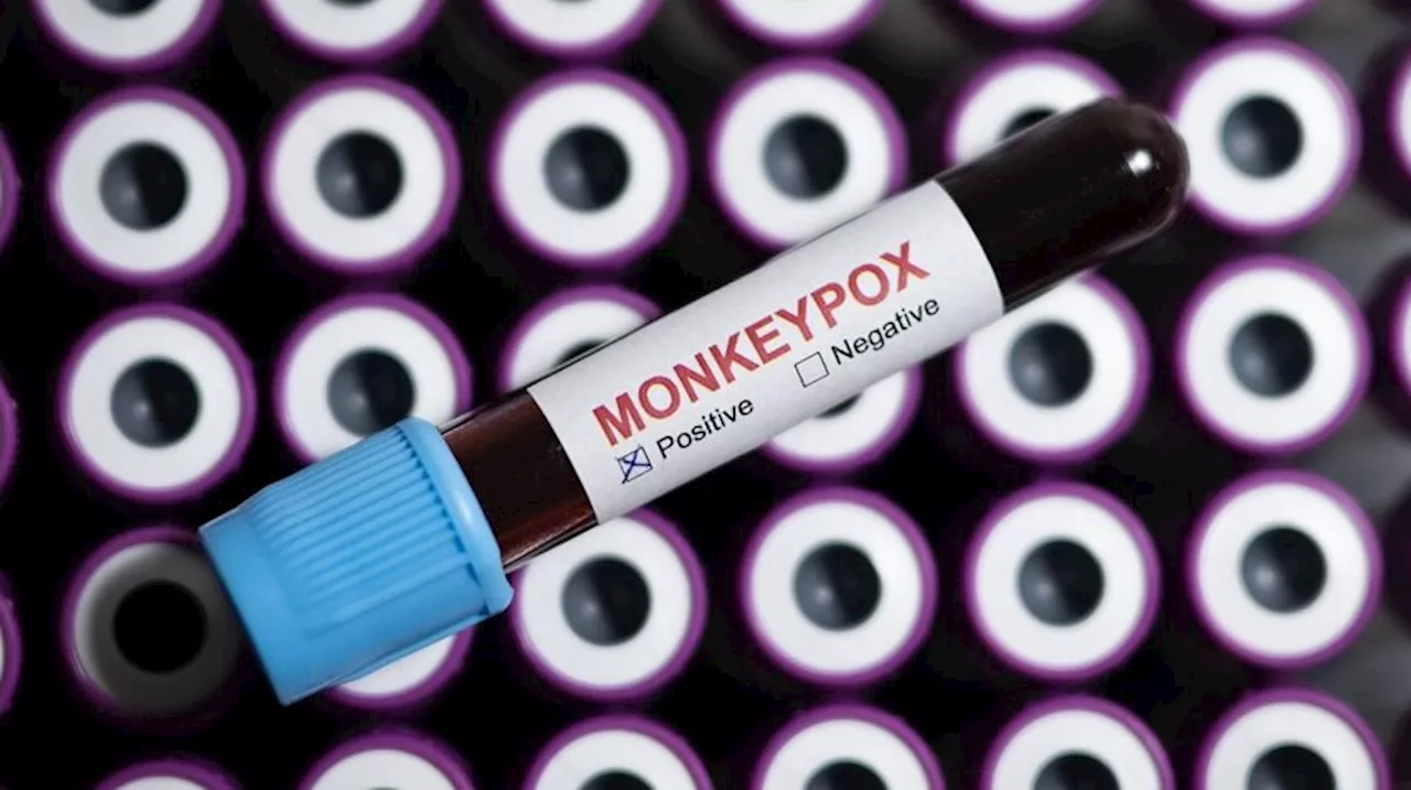 France Confirms First Case of New Monkeypox Variant