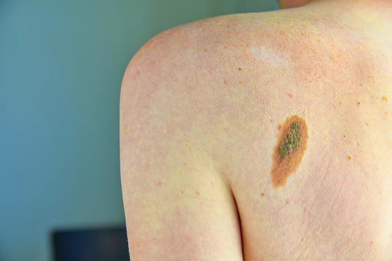 Melanoma: Previsioni Allarmanti ma Speranza grazie all'Immunoterapia