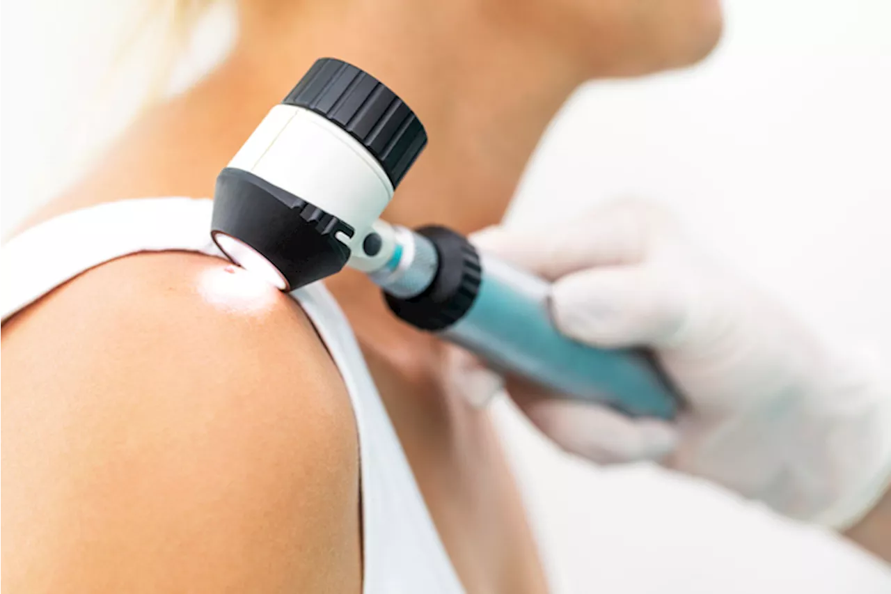 Melanoma: aumento delle diagnosi, ma l'immunoterapia offre nuove speranze