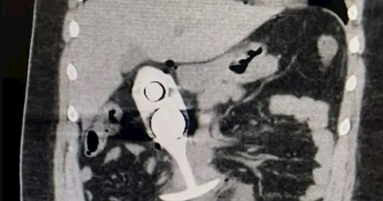 Woman Suffers Major Injuries After Sex Toy is Dragged Through Body During MRI