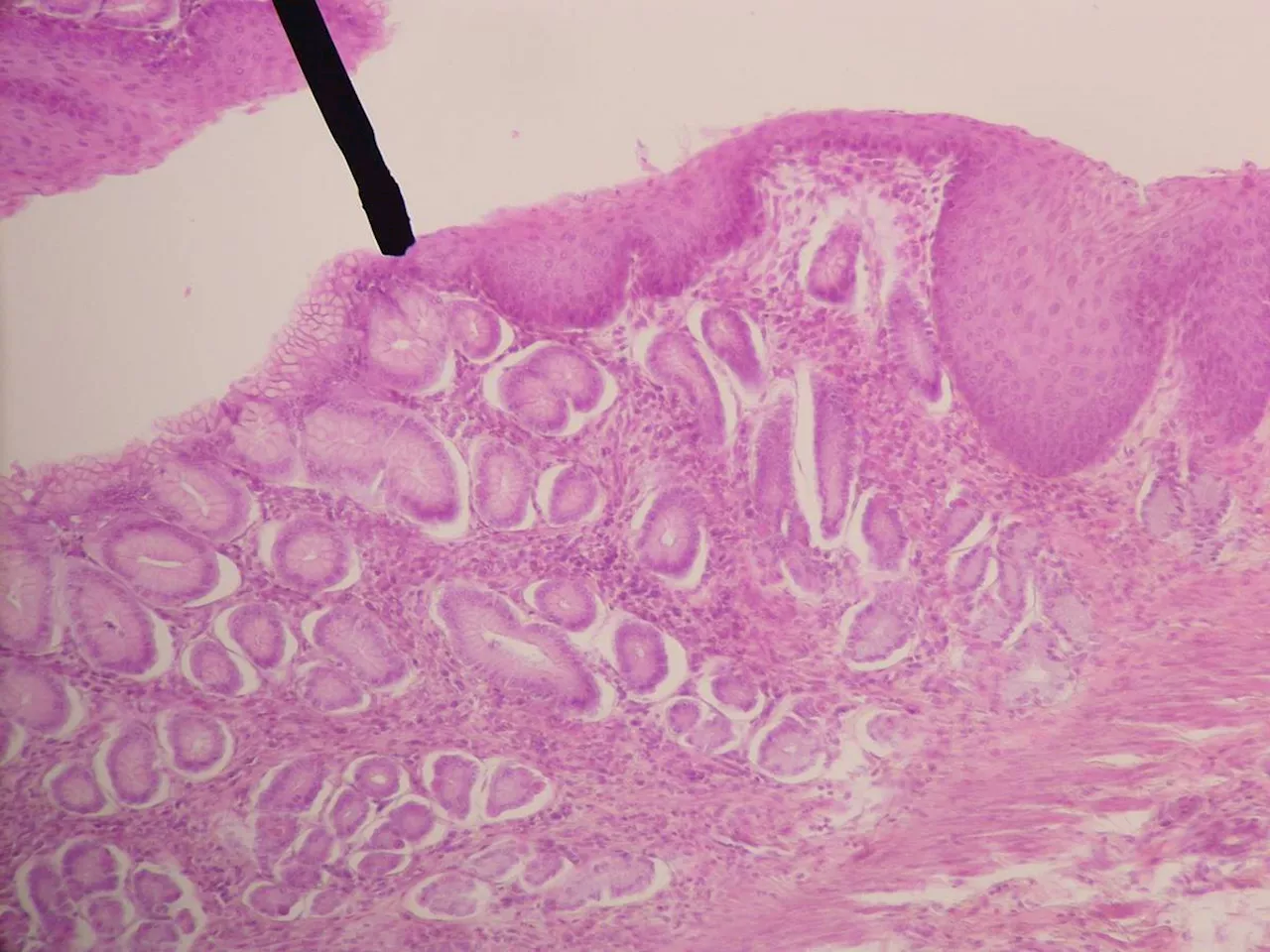 Tumore all'esofago, esordio, cause e diagnosi di una malattia insidiosa e letale