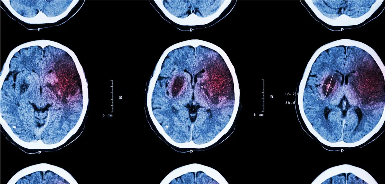 Intensivierte Schlaganfalltherapie : Kaum Vorteile durch intraarterielle Lyse während Thrombektomie