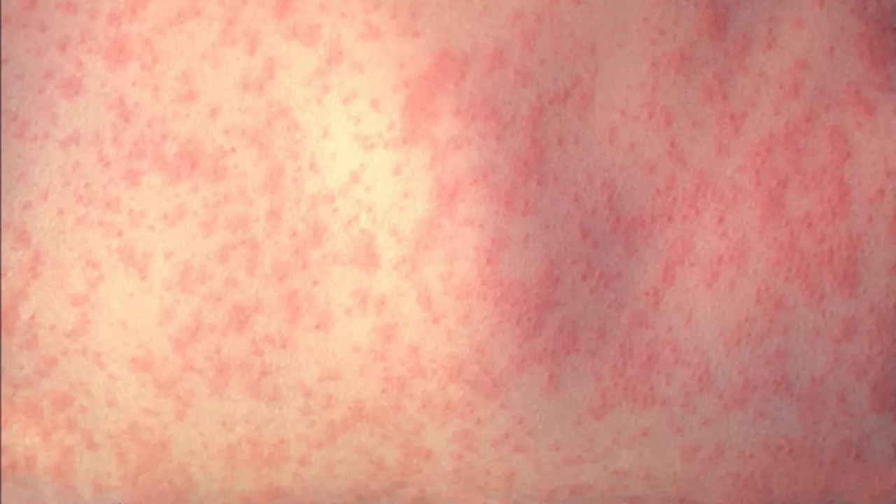 Measles Outbreak Declared in Texas County