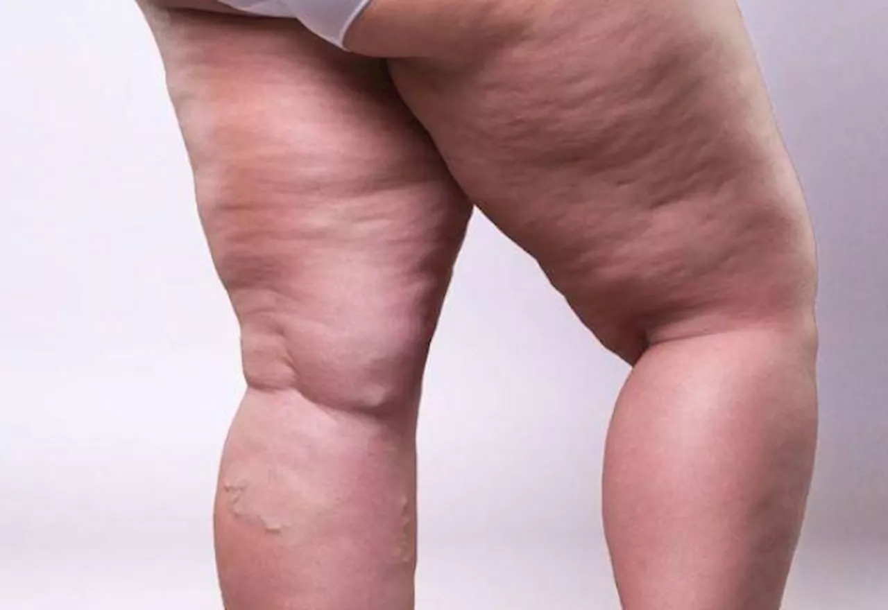 Lipedema não é obesidade: entenda a diferença e como lidar com condição