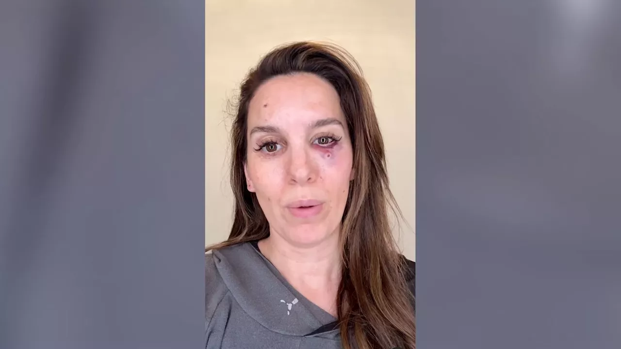 Actress Christy Carlson Romano 'grateful to be alive' after getting shot in the face